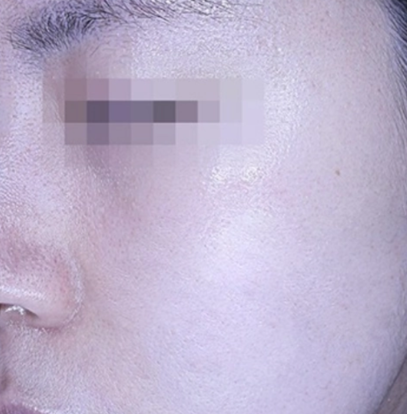 CHA.I Clinic 리쥬란 힐러 After 治疗前后对比照片