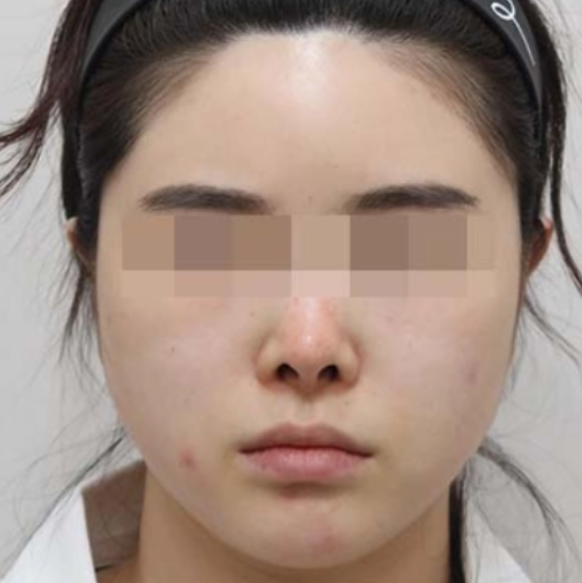 CHA.I Clinic 턱보톡스 + 조각주사 After 治疗前后对比照片