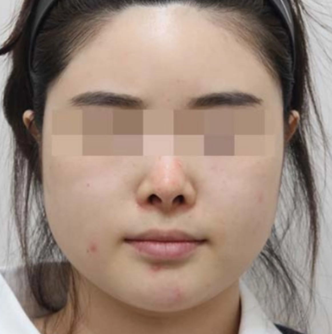 CHA.I Clinic 턱보톡스 + 조각주사 Before 治疗前后对比照片