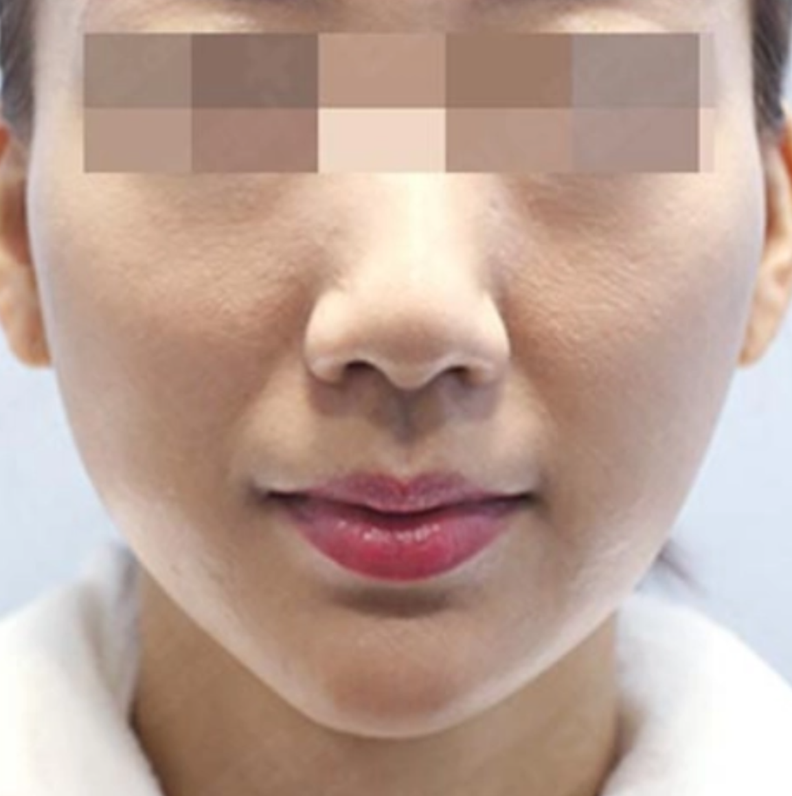 CHA.I Clinic 토링크 (코르 리프팅 + 슈링크) After 治疗前后对比照片