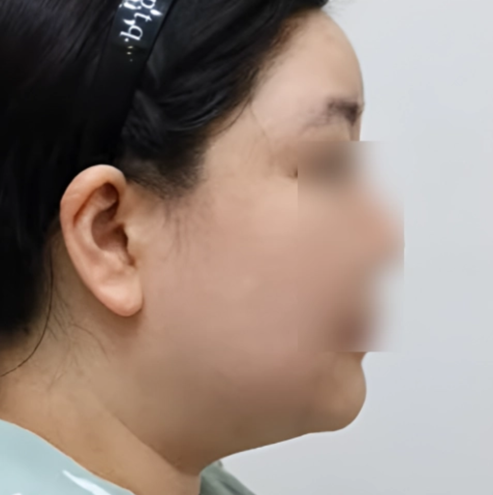 CHA.I Clinic 브이올렛 After 治疗前后对比照片