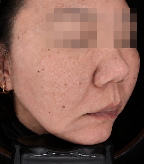 CHA.I Clinic 울쎄라 피프라임 Before 治疗前后对比照片