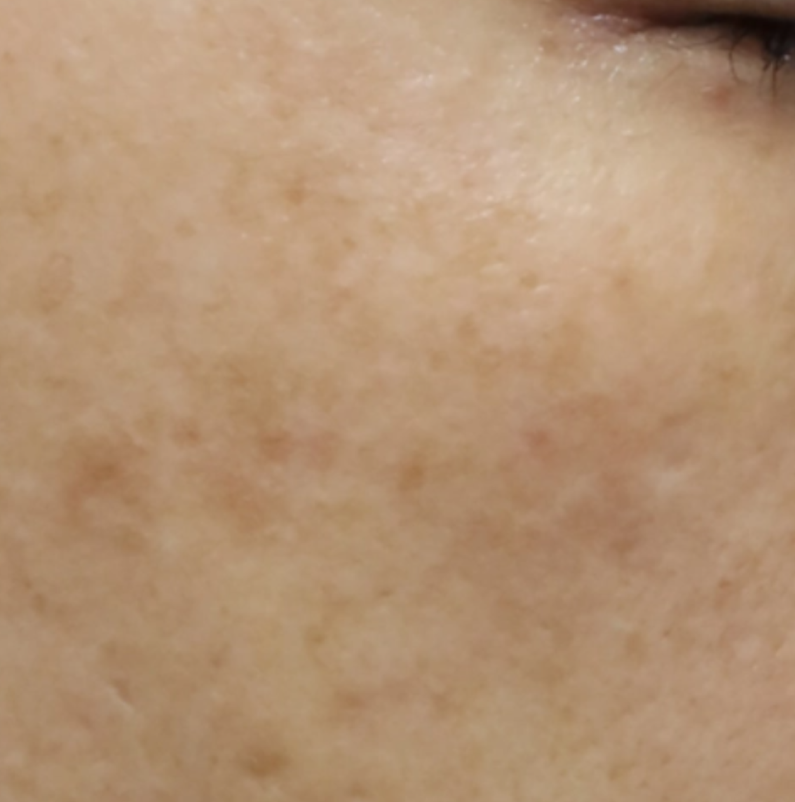 CHA.I Clinic 트리플 피코토닝 After 治疗前后对比照片