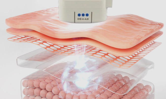 CHA.I Clinic Ultherapy