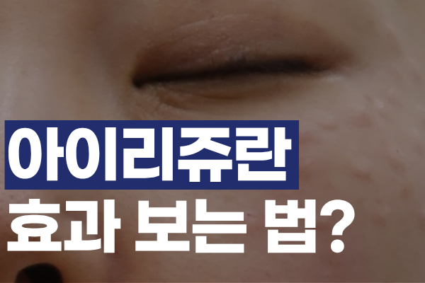 아이리쥬란, 효과 없다면 확인해야 할 것들 썸네일