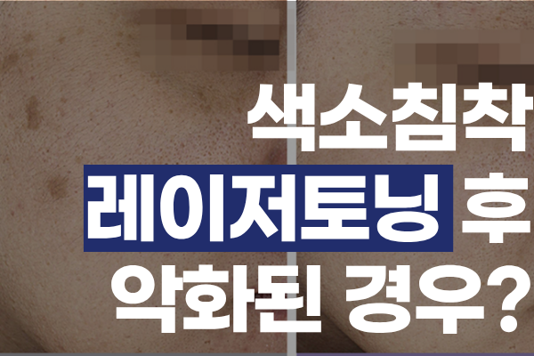 색소침착 레이저토닝 후 색소가 더 진해졌다면? 원인과 해결법 총정리 썸네일