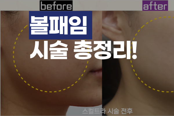 볼패임 시술 총정리, 내 얼굴에 맞는 선택은 (원인·종류·지속기간 비교)  썸네일