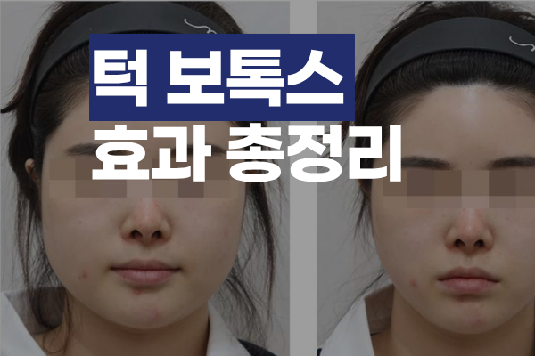 턱보톡스 효과 총정리: 변화·시점·유지기간, 효과 갈리는 이유까지 썸네일