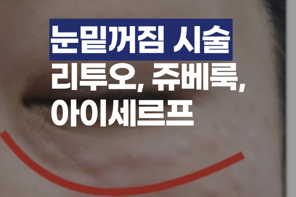 눈밑꺼짐 시술, 나한테 맞는 것은? 리투오·쥬베룩·아이세르프 차이와 선택 기준 썸네일